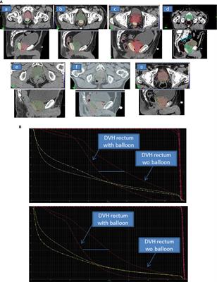 Use of a Biodegradable, Contrast-Filled Rectal Spacer Balloon in Intensity-Modulated Radiotherapy for Intermediate-Risk Prostate Cancer Patients: Dosimetric Gains in the BioPro-RCMI-1505 Study